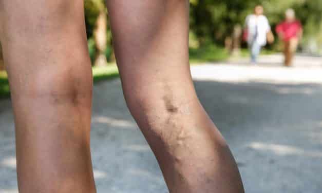 Varicose Vein Stripping Incredibly Sometimes Has Street Cred