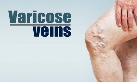 You Probably Won’t Read This Varicose Vein Article – But Should
