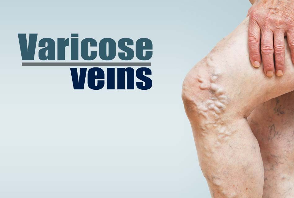 You Probably Won’t Read This Varicose Vein Article – But Should