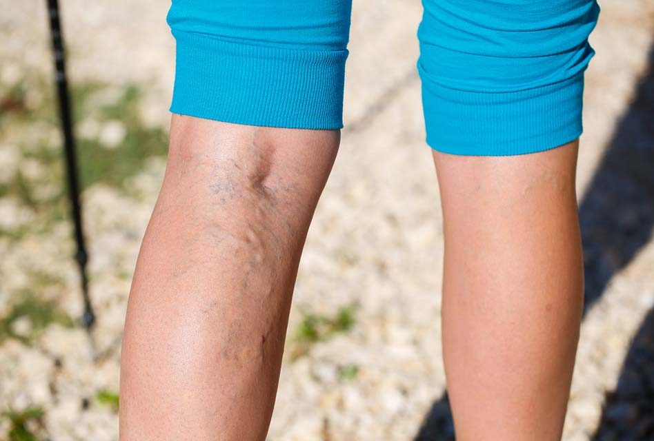 5 Facts About Varicose Veins That’ll Impress Your Friends and Family