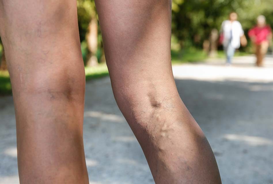 The Difference Between Varicose and Spider Veins by a Vein Doctor