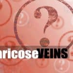 varicose veins questions