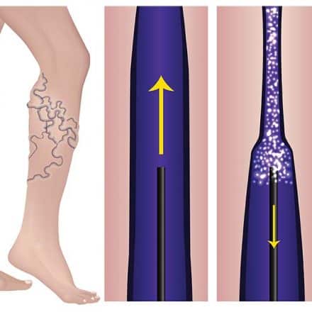 How Painful Are Varicose Vein Treatments? - Kavic Laser and Vein Center