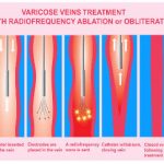 What is the Best Treatment for Varicose Veins? – Kavic Laser & Vein Center