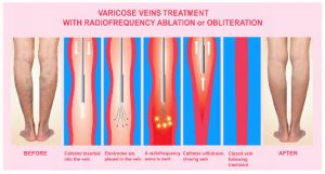 radiofrequency treatment varicose veins for chronic venous insufficiency