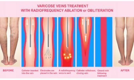 What is the Best Treatment for Varicose Veins? – Kavic Laser & Vein Center