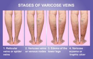 the stages of varicose veins