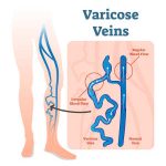 varicose veins as a manifestation of chronic venous insufficiency