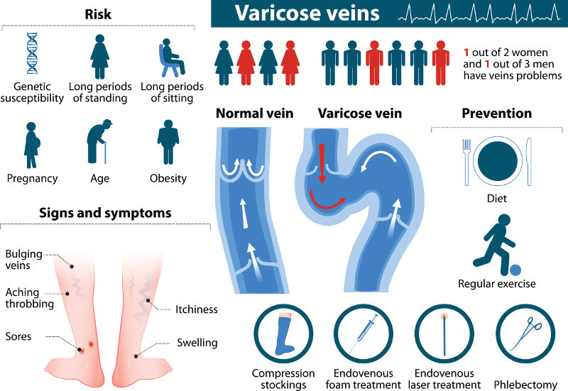 varicose veins risks treatment and symptoms
