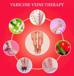 varicose vein therapies