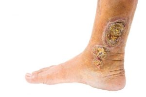 venous ulcer stage of chronic venous insufficiency