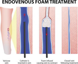 foam sclerotherapy for varicose veins