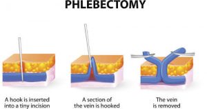 phlebectomy of varicose veins