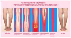 radiofrequency treatment for varicose veins